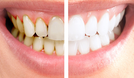 idioom Brein deugd Tanden Bleken Hoofddorp: Veilig mooie witte tanden | Tandartspraktijk  Overbos